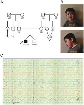 A novel loss-of-function KCNB1 gene variant in a twin with global developmental delay and seizures